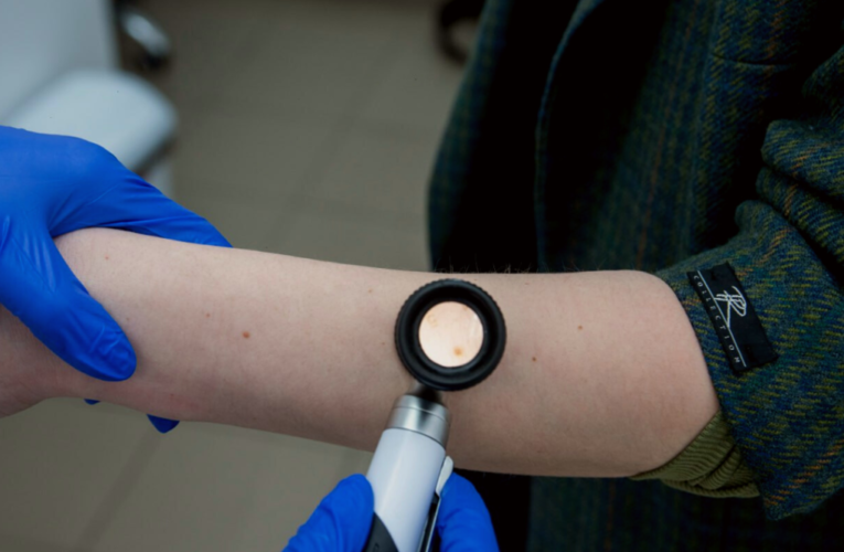 Попередити меланому: як виявити новоутворення та запобігти розвитку хвороби шкіри