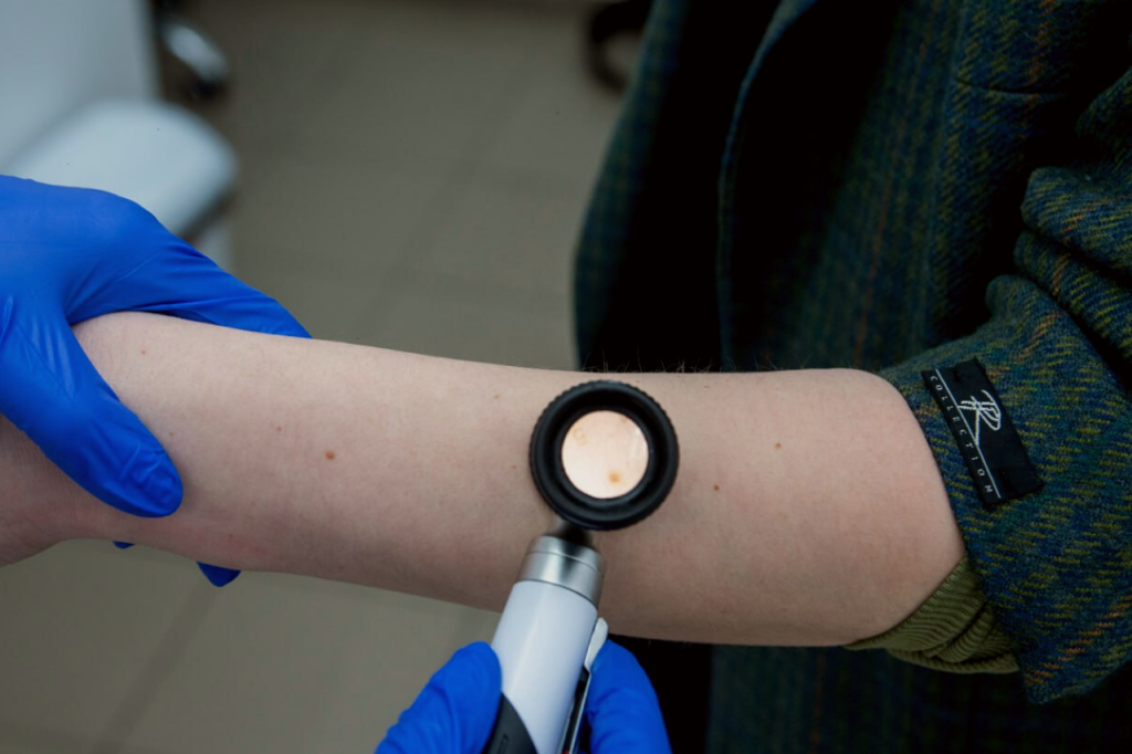 poperediti melanomu jak vijaviti novoutvorennja ta zapobigti rozvitku hvorobi shkiri 1aabb38