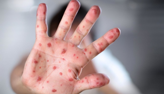 У Києві з початку року зафіксували чотири спалахи кору